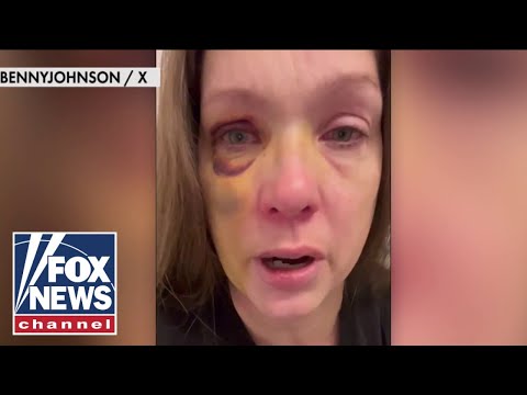 Cincinnati beating victim speaks out after brutal attack